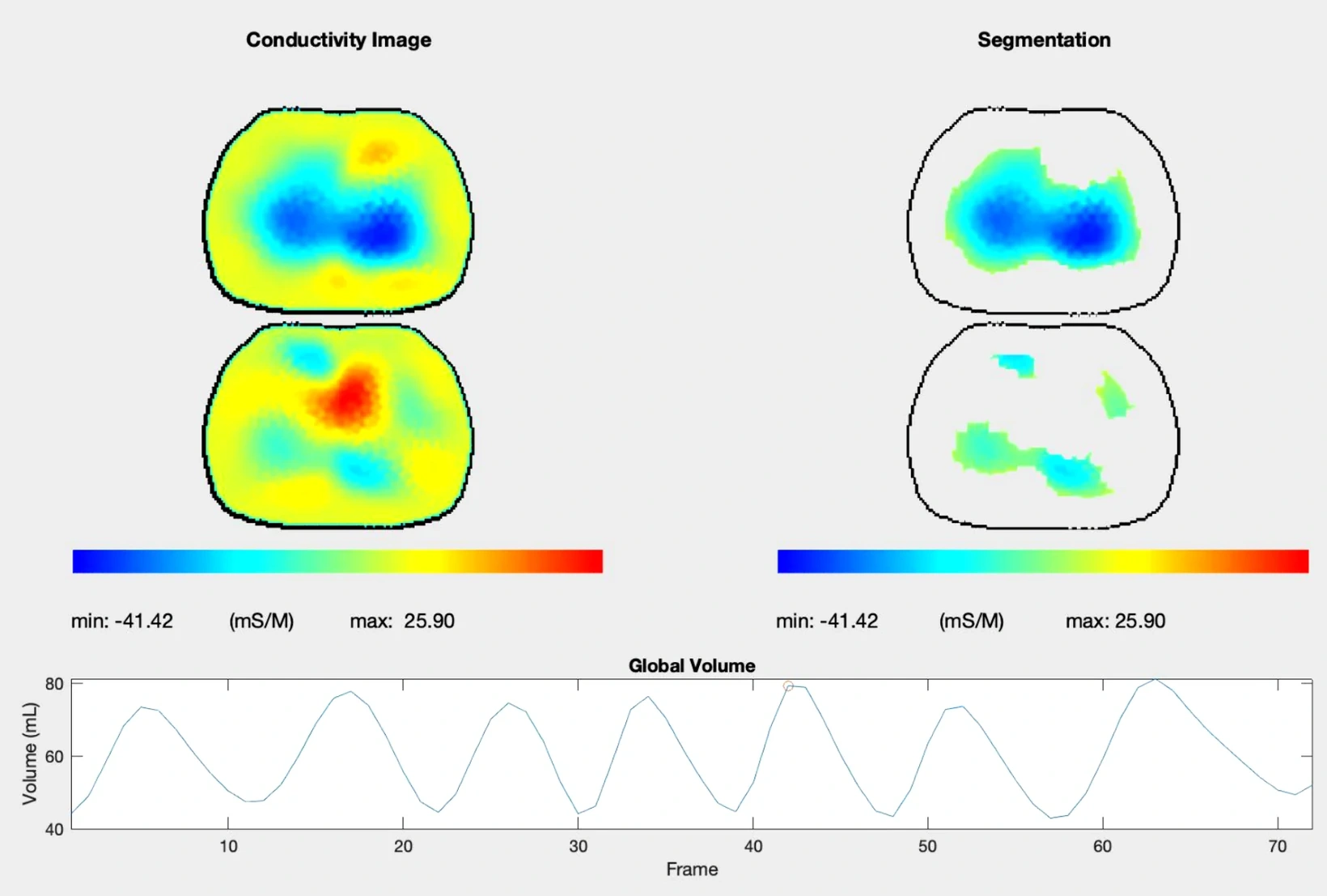 Electrical impedance tomography conductivity images, segmentation and global volume waveform